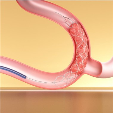Dispozitive de trombectomie Stent Retriever